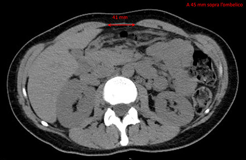 Come diagnosticare la diastasi
