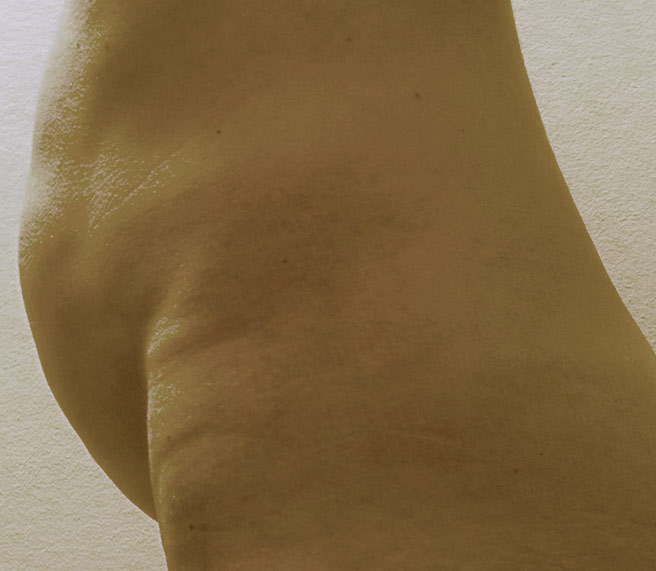 Floppy abdomen post partum